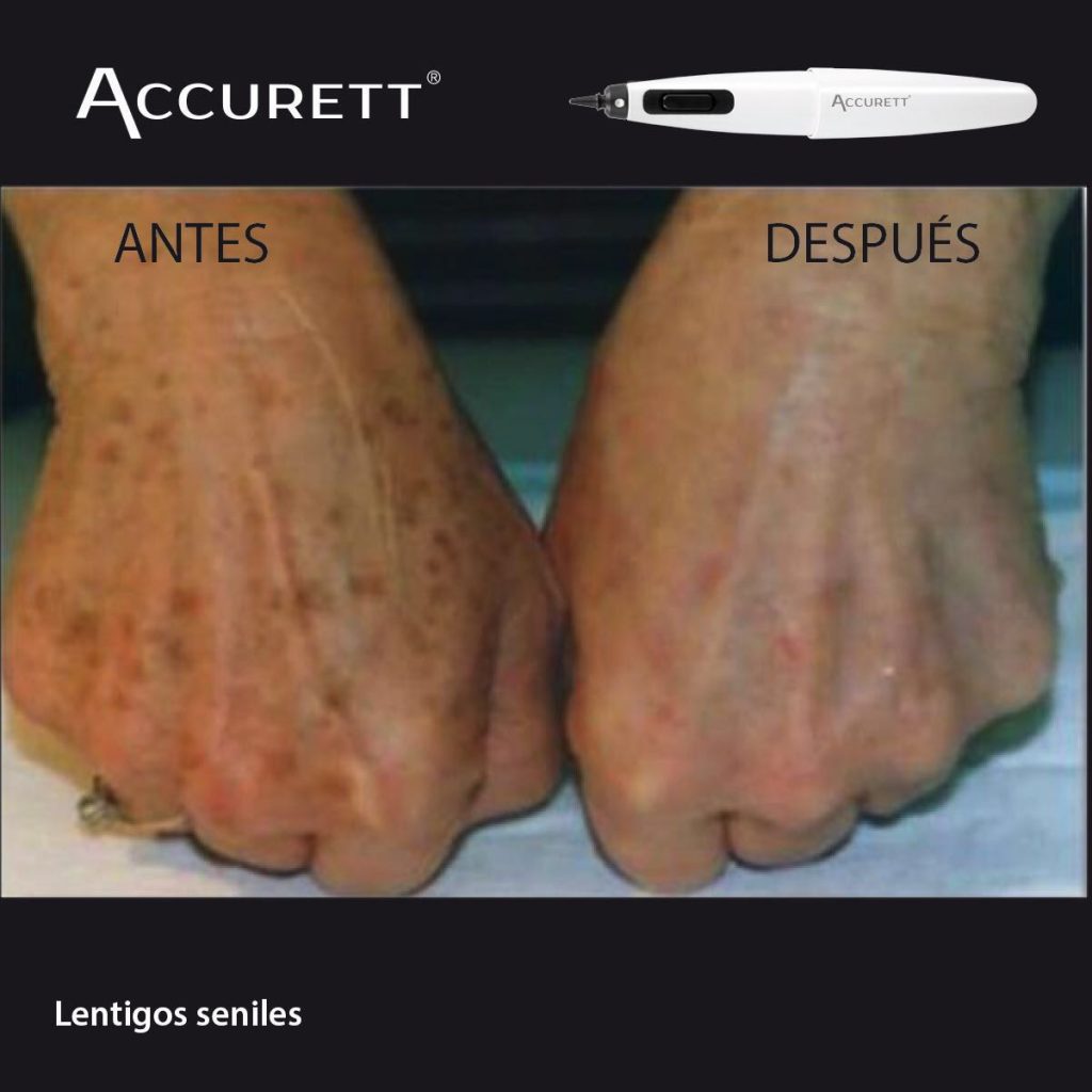 ACCURETT solucion a las manchas de la piel